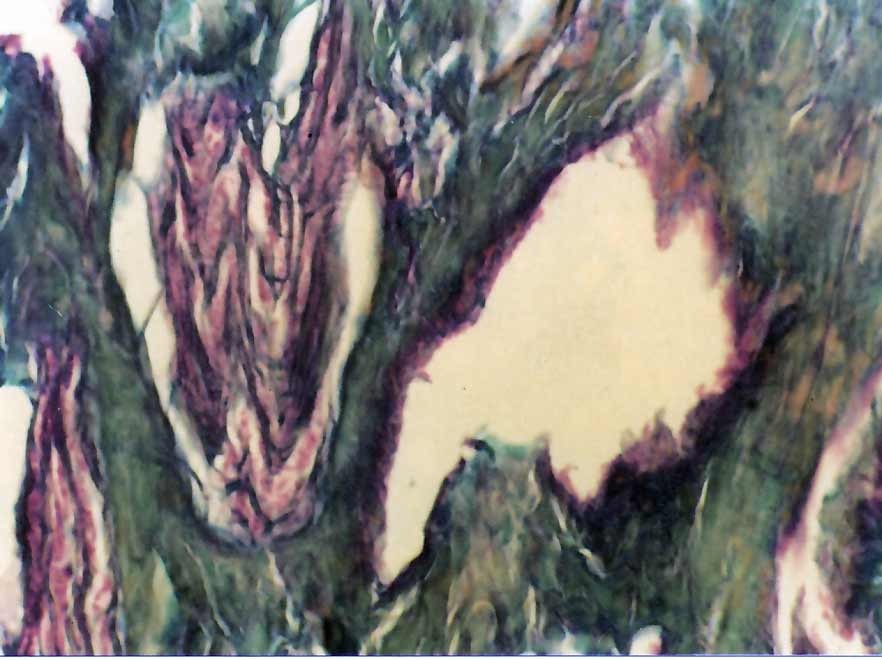 fig. 2 il cuore del miracolo di lanciano. mallory x 250 