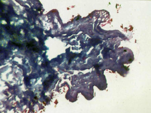 fig. 3     il cuore del miracolo di lanciano.  mallory x 